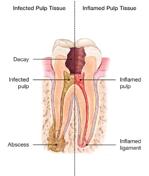 Root Canal Therapy Kalamazoo