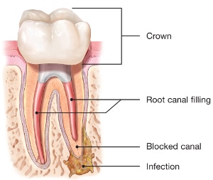 endodontic-retreatment-root-canal-kalamazoo