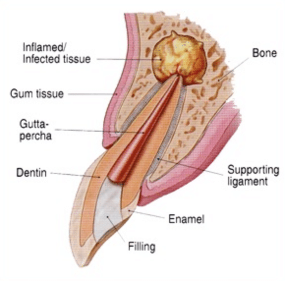 kalamazoo-apicoectomy-1