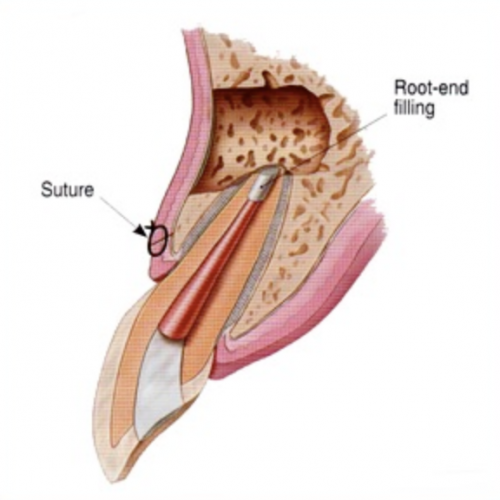 kalamazoo-apicoectomy-2