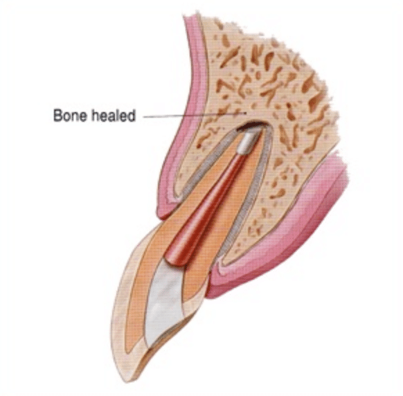 kalamazoo-apicoectomy-3