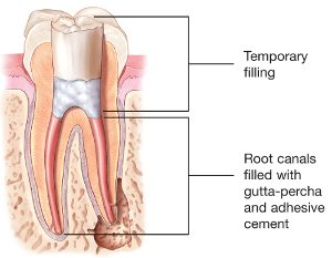 root canal 3 kalamazoo