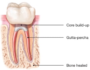 root canal 4 kalamazoo