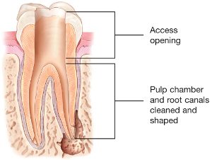 root canal kalamazoo